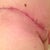 Post Op 8 weeks, right side scar