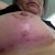 Right under healed 11 weeks
