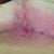 Left under healed 11 weeks