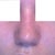 My nose after my surgeon pushed the bone back in place.