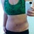 week 4... still a bit lopsided with the swelling. Scar is also higher on one side