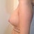 Profile - One Week Postop