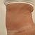 10 weeks post op