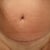 10 weeks post op