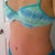 3 month post op