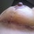 Day 12 PO: Left breast incision.