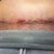Day 12 PO: Close up of belly incision where it is irritated from binder. Doesn't hurt - just a bit annoying and it itches ferociously.
