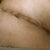 Day 12 PO: Close up of my right side of the belly incision. Sounds like the puckering will smooth out over time.