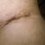 Day 12 PO: Left side belly incision.