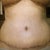 Day 12 PO: Belly shot - swelling is down on the left side. Sides look more scooped, which leads me to believe swelling has been reduced a bit.