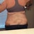Po day 6 swollen and ugly. Hoping this improves!