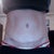 4 months post op