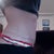 4 months post op