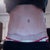4 months post op