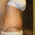 9 days PO side- some bunching.  Dr T said that once my inside stitches dissolve that the skin will lay more flat