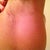 Scar Underarm - 3 Weeks