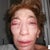 Although my right eye area is still very swollen from eye procedures performed by an ocular surgeon at this same surgery, it is evident that Dr. Aronowitz did not add enough stem cell fat to my right cheek.