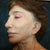 Dr. Aronowitz Before Photo. The “easiest” procedure was supposed to correct the inward curl of my left earlobe.