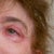 Post-surgery, the earlobe curl is still present as Dr. Aronowitz forgot to re-attach my earlobe to my face.  The left earlobe is also longer than my right.