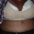Next day, after wrap was removed