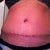 Self portrait taken Day 19.  You can see to the side how there is a "ridge."  This is completely normal and nothing to worry about if you have the same thing.  That will subside over time.