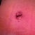 Belly button close up Day 19.  I am very happy!  I always had a horizontal belly button and even was I was super thin in my 20's, it still never looked that good to me.  I never liked it, so I asked Dr Wotowic to please make sure that this one is not "sideways"  :)