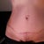 front view 1 yr post op