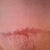 mid section scar