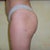Left side 5 months post op