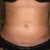 Zoomed in belly.  If you look carefully, you can see the lower left is a bit swollen.  That's my hard spot.  My holes have closed up.