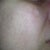 Right side of face - 8 days after IPL.