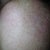 Left side of face - 8 days after IPL.
