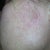 Left side of face - 8 days after IPL.