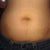 Abdomen not too much bruising but painful, pic minutes after the procedure