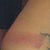 Bruising, picture taken day after the procedure. (Both sides are equally bruised)