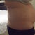 Closer up side view and bra roll before liposuction