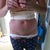 8 Days PO - redressed myself, still loadssss of swelling but going down gradually