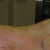 some liposuction incsision sights