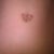 Belly button before revision.