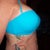 3 months post op