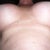scars almost gone!!!! Then one on the left stuck to my bra one day when it was humid out. Scar gel stuck to it
