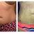 Before and 2 weeks po