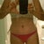 TT looking better … end of 2 weeks post-op