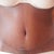 PO 7 weeks - Incision close up