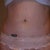 2 weeks after I finished Smoothshapes (6.5 months post-surgery).