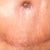 Week 4 scar healing so nicely at front