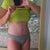 3 month post op