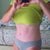 3 months post op
