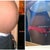 Before and After...11 Days Post Op