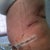 Side view after 3 days po.  Can totally see the swelling, but I'm content so far